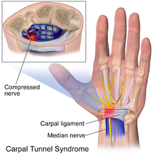 St. Louis carpal tunnel lawyer