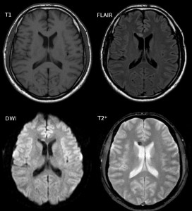 concussions